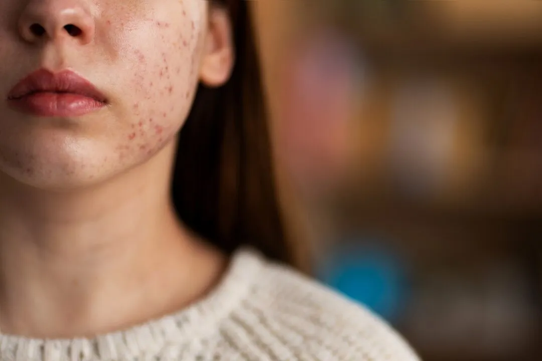 Acne Treatment Vapi