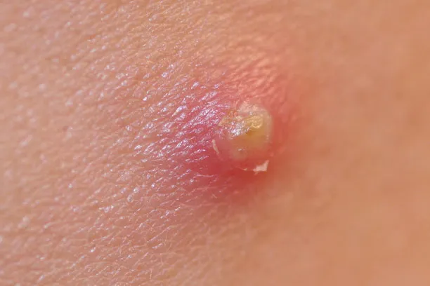 Treating boils on the skin