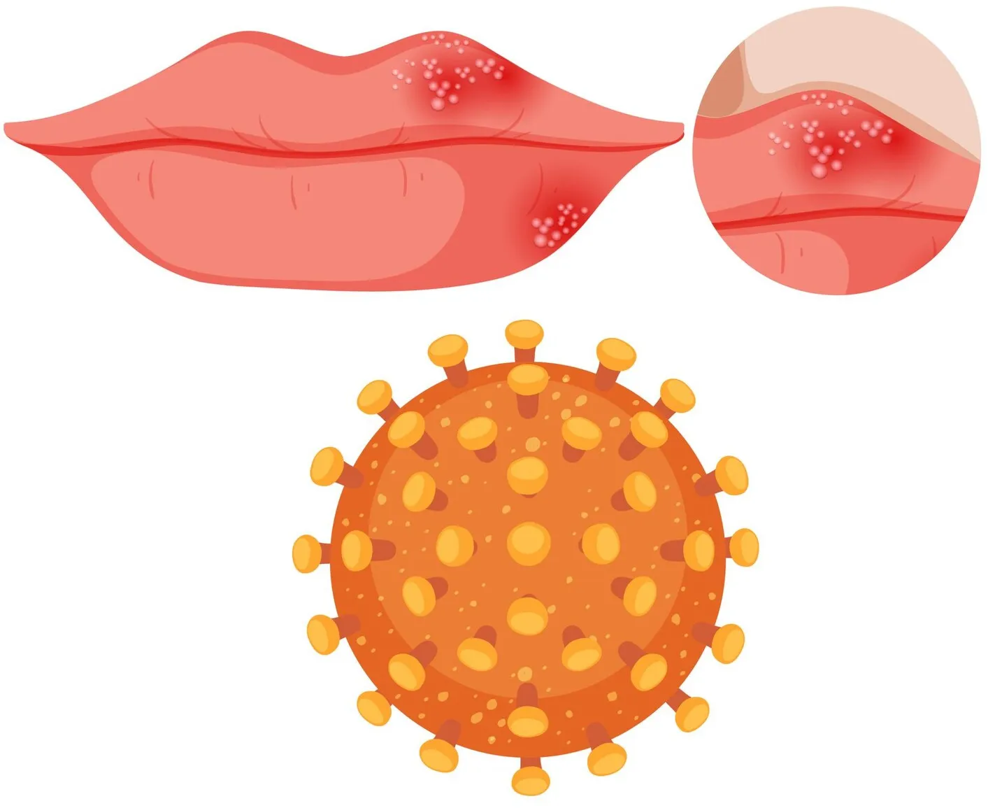 Managing herpes outbreaks