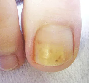 Fungal nail treatment