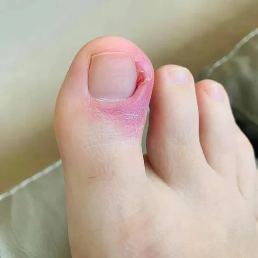 Nail avulsion procedure