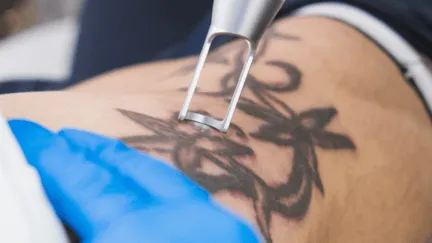 Tattoo removal illustration