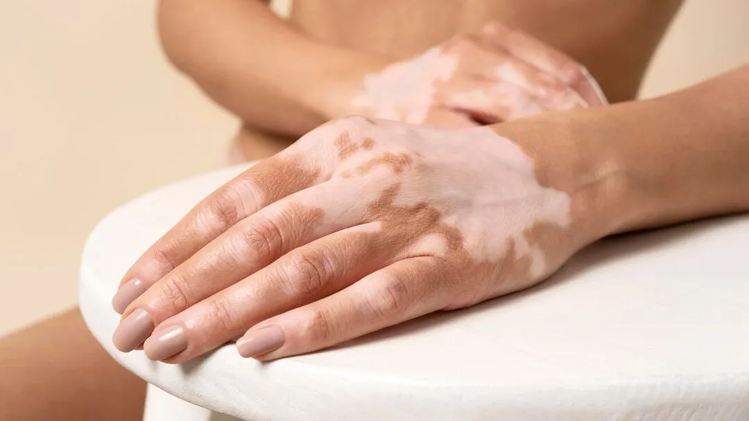 Vitiligo care illustration